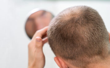 Calvície: novo medicamento contra queda de cabelo é apontado como o maior avanço em décadas