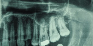 USP desenvolve IA que ajuda dentistas a detectar cáries em radiografias